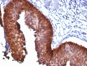 IHC staining of FFPE human bladder carcinoma with Cytokeratin 17 antibody (clone E3).