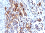 IHC testing of FFPE human gastric carcinoma stained with MUC5AC antibody (clone 45M1).