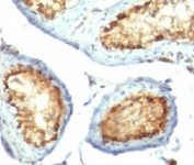 IHC testing of FFPE human testicular carcinoma with Mitochondrial Marker antibody (clone 113-1)