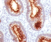 IHC CEA antibody C66/1030 colon carcinoma