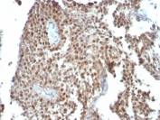 IHC: Formalin-fixed, paraffin-embedded human colon carcinoma stained with anti-p21 antibody (clone SPM306).