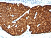 IHC: Formalin-fixed, paraffin-embedded human pheochromocytoma stained with Chromogranin A antibody (CGA/413)