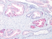 Formalin-fixed, paraffin-embedded human prostate carcinoma stained with p504S antibody (13H4)