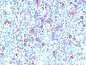 IHC: Formalin-fixed, paraffin-embedded human melanoma stained with Glypican-3 antibody (clone SPM595). HIER: boil tissue sections in pH 9 10mM Tris with 1mM EDTA for 20 min and allow to cool before testing.