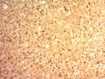 IHC: Formalin-fixed, paraffin-embedded human hepatocellular carcinoma stained with Glypican-3 antibody (clone SPM595). HIER: boil tissue sections in pH 9 10mM Tris with 1mM EDTA for 20 min and allow to cool before testing.