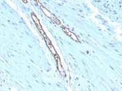 IHC: Formalin-fixed, paraffin-embedded human colon carcinoma stained with Blood Group Antigen A antibody (HE-193)