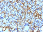 IHC staining of FFPE human histiocytoma tissue with HLA-DRB1 antibody (clone LN3). HIER: boil tissue sections in pH 9 10mM Tris with 1mM EDTA for 20 min and allow to cool before testing.