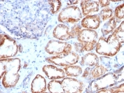IHC: Formalin-fixed, paraffin-embedded human renal cell carcinoma stained with HSP60 antibody (clone HSPD1/780).