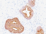 IHC: Formalin-fixed, paraffin-embedded human prostate carcinoma stained with Prostate Specific Antigen antibody (1A7).