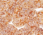 IHC: Formalin-fixed, paraffin-embedded human colon carcinoma stained with Cytokeratin 18 antibody.