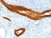 IHC: Formalin-fixed, paraffin-embedded human endometrial carcinoma stained with EpCAM antibody (MOC-31).
