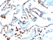 IHC analysis of FFPE human lung carcinoma tested with MFGE8 antibody (clone MFG-06).