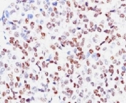 IHC: Formalin-fixed, paraffin-embedded human melanoma stained with anti-MITF antibody (clone SPM290).