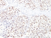 IHC: Formalin-fixed, paraffin-embedded human melanoma stained with MITF antibody cocktail (clones D5 + MITF/915).