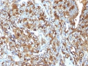 Formalin-fixed, paraffin-embedded human breast carcinoma stained with MUC1 antibody (MUC1/520).