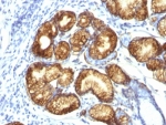 IHC: Formalin-fixed, paraffin-embedded human gastric carcinoma stained with MUC6 antibody (clone CLH5). HIER: steam section in pH6 citrate buffer for 20 min and allow to cool prior to testing.