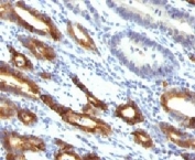 IHC: Formalin-fixed, paraffin-embedded human gastric carcinoma stained with Mucin-6 antibody (MUC6/916).