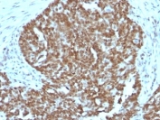 IHC: Formalin-fixed, paraffin-embedded human ovarian carcinoma stained with Nucleolin antibody.