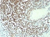 IHC: Formalin-fixed, paraffin-embedded human bladder carcinoma stained with Nucleolin antibody (364-5 + NCL/902).
