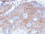 IHC: Formalin-fixed, paraffin-embedded human cervical carcinoma stained with Beta-2-Microglobulin antibody (clone B2M/1118).