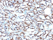 IHC: Formalin-fixed, paraffin-embedded human angiosarcoma stained with ACTA2 antibody cocktail (clone 1A4 + ACTA2/791).