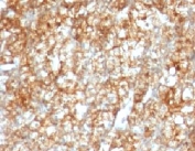IHC: Formalin-fixed, paraffin-embedded human renal cell carcinoma stained with CD147 antibody (BSG/963).