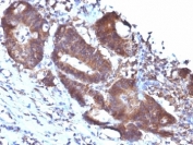 IHC: Formalin-fixed, paraffin-embedded human colon carcinoma stained with SM22 antibody (TAGLN/247)
