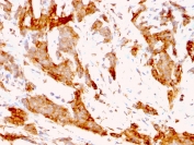 IHC analysis of formalin-fixed, paraffin-embedded human breast carcinoma tissue stained with GRP94 antibody (clone 9G10.F8.2). HIER: boil tissue sections in pH 9 10mM Tris with 1mM EDTA for 20 min and allow to cool before testing.