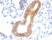 IHC: Formalin-fixed, paraffin-embedded human melanoma stained with CD86 antibody (clone SPM600).
