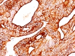 IHC: Formalin-fixed, paraffin-embedded human colon carcinoma stained with Cytokeratin 5/8 antibody (SPM268).