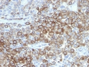 IHC anlaylsis of formalin-fixed, paraffin-embedded human melanoma stained with Melanoma antibody (clone PNL2).