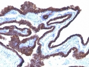 IHC: Formalin-fixed, paraffin-embedded human ovarian cancer stained with Cytokeratin 8/18 antibody (C-43 + DC10).