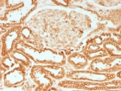 IHC testing of FFPE human renal cell carcinoma with Calnexin antibody. HIER: boil tissue sections in 10mM Tris with 1mM EDTA, pH 9.0 for 10-20 min.