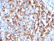 IHC testing of FFPE human melanoma stained with MART-1 antibody. HIER: steam sections in pH 9 10mM Tris with 1mM EDTA for 10-20 min.