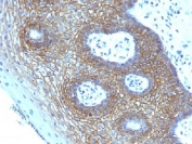IHC testing of FFPE human cervical squamos cell carcinoma with CD44v4 antibody (clone CD44v4/1219). Required HIER: steam sections in pH 9 10mM Tris with 1mM EDTA buffer for 10-20 min.