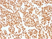 IHC testing of FFPE human prostate carcinoma with FOXA1 antibody (clone FOXA1/1515). HIER: boil sections in 10mM Tris with 1mM EDTA, pH9, for 10-20 min.