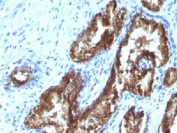 IHC testing of FFPE human prostate carcinoma with TDP2 antibody (clone TDP2/1258). Required HIER: boil tissue sections in 10mM Tris with 1mM EDTA, pH 9, for 10-20 min followed by cooling at RT for 20 min.
