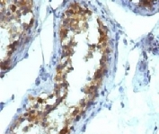 IHC testing of FFPE testicular carcinoma and Alkaline Phosphatase antibody (KSUL-1). Required HIER: boil tissue sections in 10mM Tris with 1mM EDTA, pH 9, for 10-20 min followed by cooling at RT for 20 min.