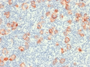 IHC testing of FFPE Hodgkin