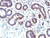 IHC testing of FFPE human breast carcinoma with recombinant Ferritin Light Chain antibody (clone FTL/2338R). Required HIER: boil tissue sections in pH6, 10mM citrate buffer, for 10-20 min followed by cooling at RT for 20 min.