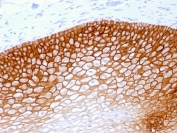 IHC testing of FFPE human cervical squamos cell carcinoma with recombinant CD44v4 antibody (clone rCD44v4/1219). Required HIER: steam sections in pH 9 10mM Tris with 1mM EDTA buffer for 10-20 min.