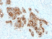 IHC testing of FFPE human colon carcinoma with CD66 antibody (clone C66/2055R). Required HIER: boil tissue sections in pH 9 10mM Tris with 1mM EDTA for 10-20 min followed by cooling at RT for 20 min.