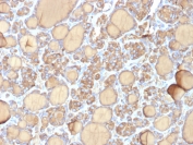 IHC: Formalin-fixed, paraffin-embedded human thyroid gland stained with recombinant TG antibody (clone r6E1). Required HIER: boil tissue sections in pH 9 10mM Tris with 1mM EDTA for 10-20 min followed by cooling at RT for 20 min.