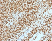 IHC testing of FFPE Ewings sarcoma with NKX2.2 antibody (clone RMNK2-2). HIER: steam sections in pH 9 10mM Tris with 1mM EDTA for 10-20 min.