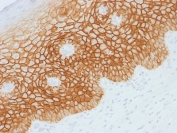 IHC testing of FFPE human cervical squamos cell carcinoma with CD44v4 antibody. Required HIER: steam sections in pH 9 10mM Tris with 1mM EDTA buffer for 10-20 min.