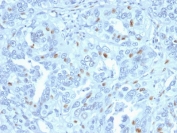 IHC testing of FFPE human endometrial carcinoma with Cyclin A2 antibody. Required HIER: steam section in pH6 citrate buffer for 20 min and allow to cool prior to staining.