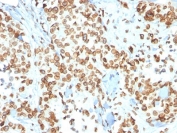 IHC testing of FFPE human breast carcinoma with Emerin antibody (clone EMD/2167). Required HIER: boiling tissue sections in 10mM citrate buffer, pH 6, for 10-20 min and allow to cool prior to staining.