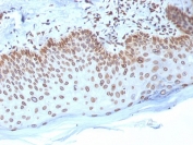 IHC testing of FFPE human breast carcinoma with Emerin antibody (clone EMD/2168). Required HIER: boiling tissue sections in 10mM citrate buffer, pH 6, for 10-20 min and allow to cool prior to staining.