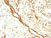 IHC testing of FFPE human renal cell carcinoma with Emerin antibody (clone EMD/2168). Required HIER: boiling tissue sections in 10mM citrate buffer, pH 6, for 10-20 min and allow to cool prior to staining.