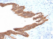 IHC testing of FFPE human pancreatic carcinoma with TROP2 antibody (clone TACSTD2/2152). Required HIER: boil tissue sections in pH 9 10mM Tris with 1mM EDTA for 10-20 min followed by cooling at RT for 20 min.